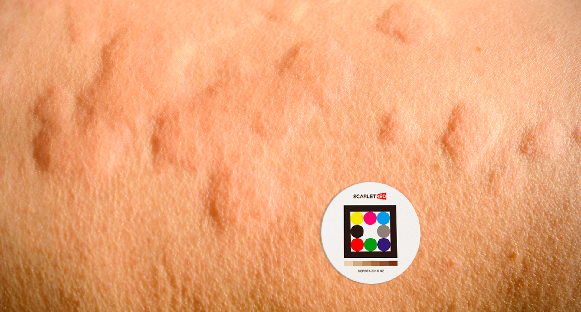 Chronic Spontaneous Urticaria Management: Scarletred®Vision's Innovative Approach