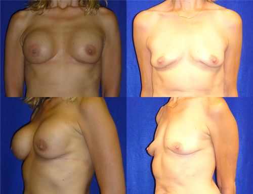 Breast Implant Removal Before & After Patient #5895
