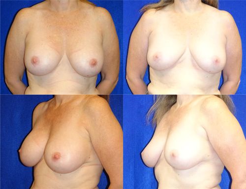 Breast Implant Removal Before & After Patient #5895