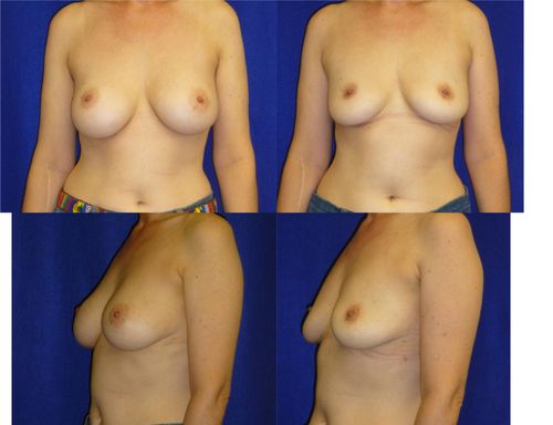 Breast Implant Removal Before & After Patient #5895