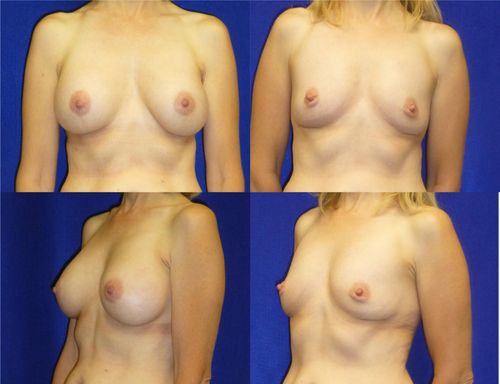 Breast Implant Removal Before & After Patient #5895
