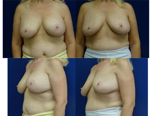 Breast Implant Removal Before & After Patient #5895
