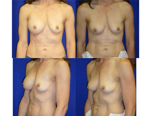 Breast Implant Removal Before & After Patient #5895