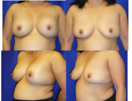 Breast Implant Removal Before & After Patient #5895