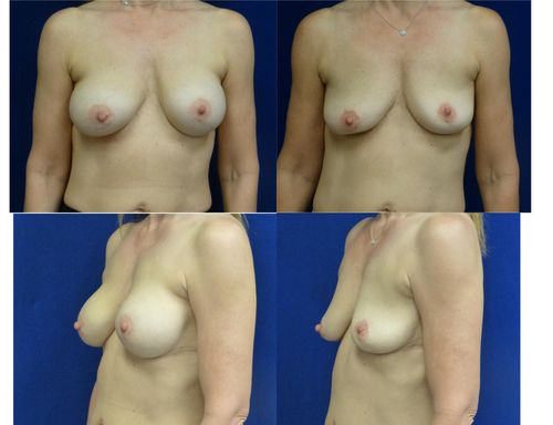 Breast Implant Removal Before & After Patient #5895