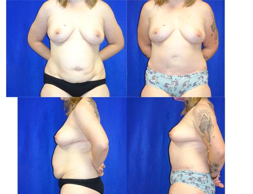 Breast Lift Before & After Patient #1297
