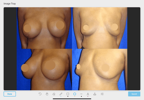 Breast Implant Removal Before & After Patient #5895