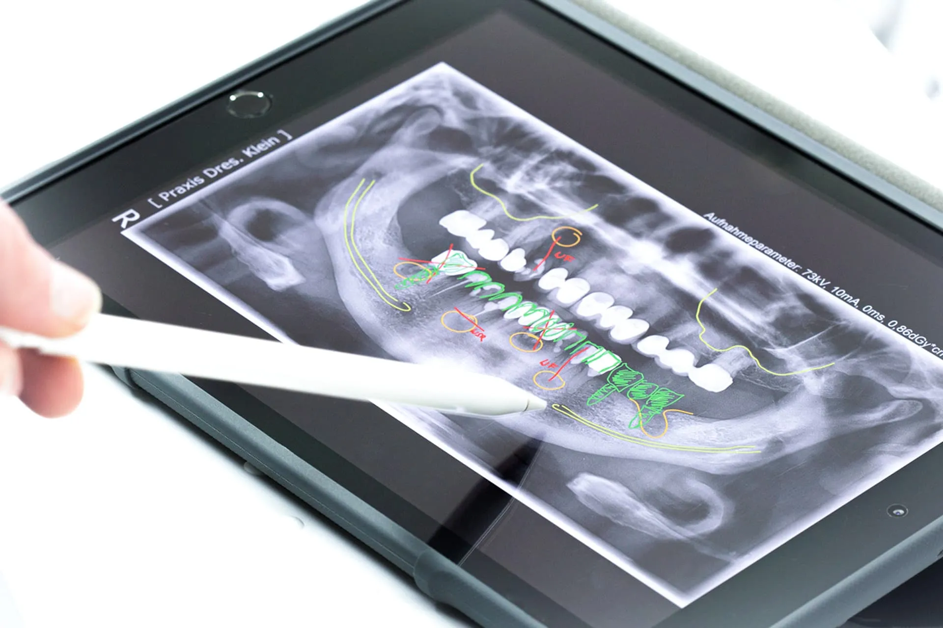 Zahnärztliche Röntgenaufnahme auf einem Tablet, mit einem Stift markiert und farblich hervorgehobenen Behandlungsbereichen.