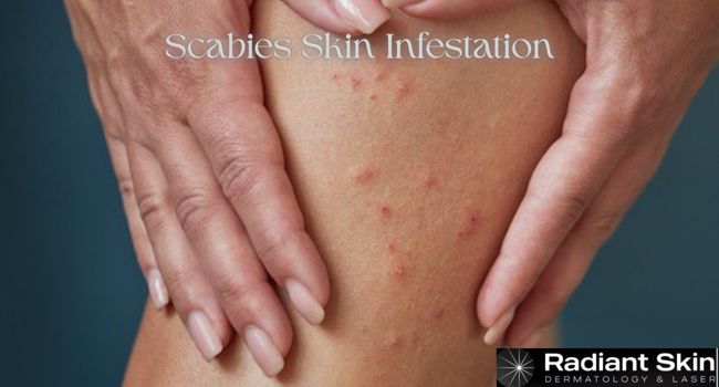 Scabies Skin Infestation: Symptoms, Causes, and Treatment in Harlem