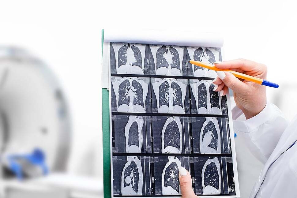 Under Current Guidelines, Most Lung Cancer Patients Weren't Eligible for Cancer Screening