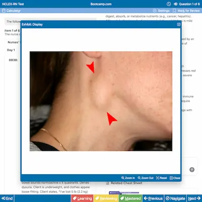 Close-up of a person's neck and jawline with two red arrows pointing to swollen lymph nodes under the skin.
