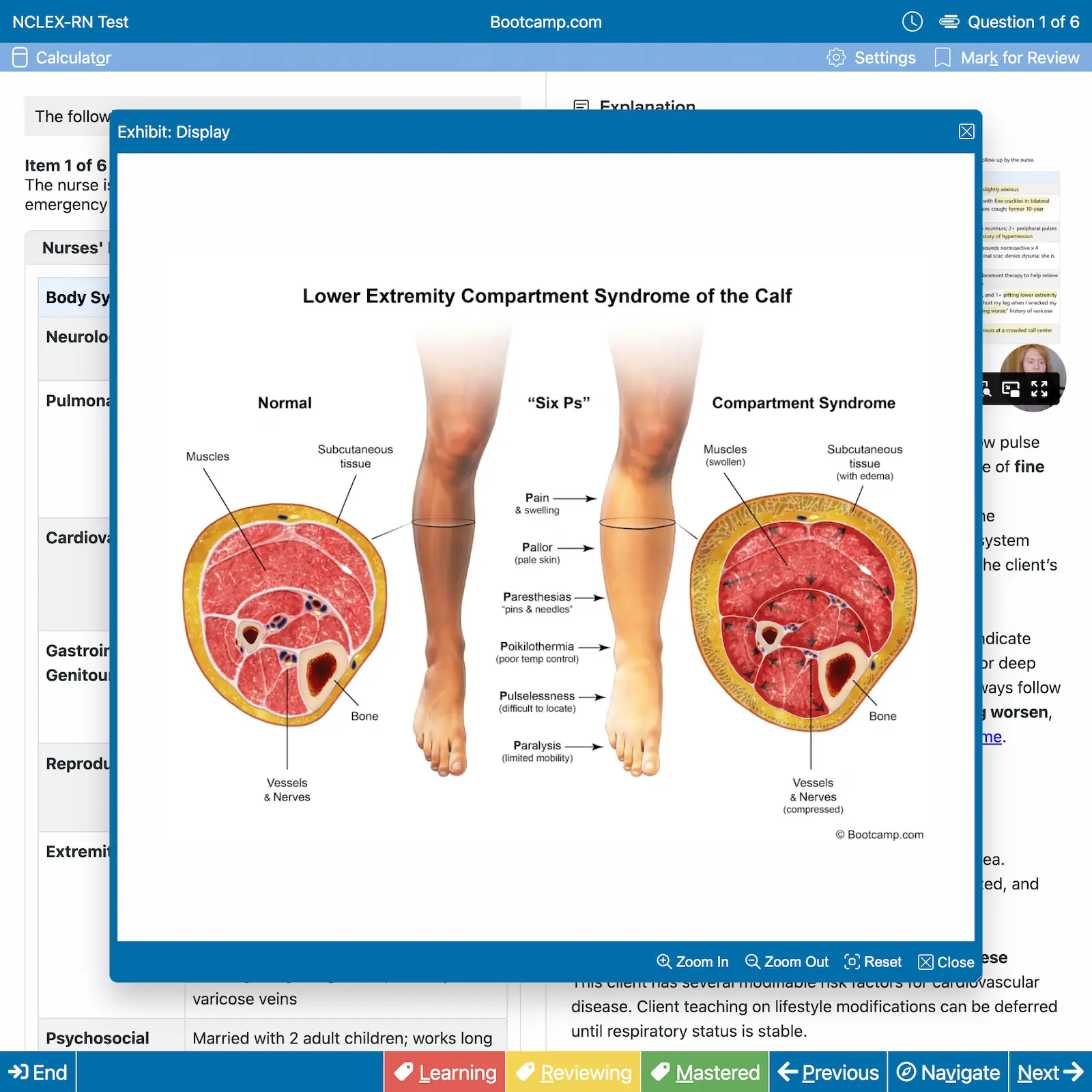 Diagram comparing normal calf anatomy with lower extremity compartment syndrome, showing cross-sections of muscles, bone, vessels, and nerves, alongside symptoms labeled as the 'Six Ps' including pain, pallor, paresthesias, poikilothermia, pulselessness, and paralysis.