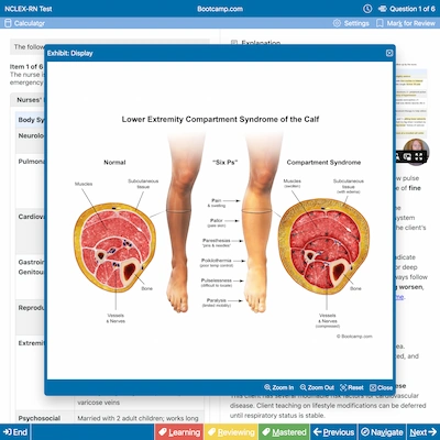 Medical illustration showing cross-sections of a normal calf and one with lower extremity compartment syndrome, highlighting muscles, subcutaneous tissue, vessels and nerves, along with symptoms like pain, pallor, paresthesia, pulselessness, and paralysis.