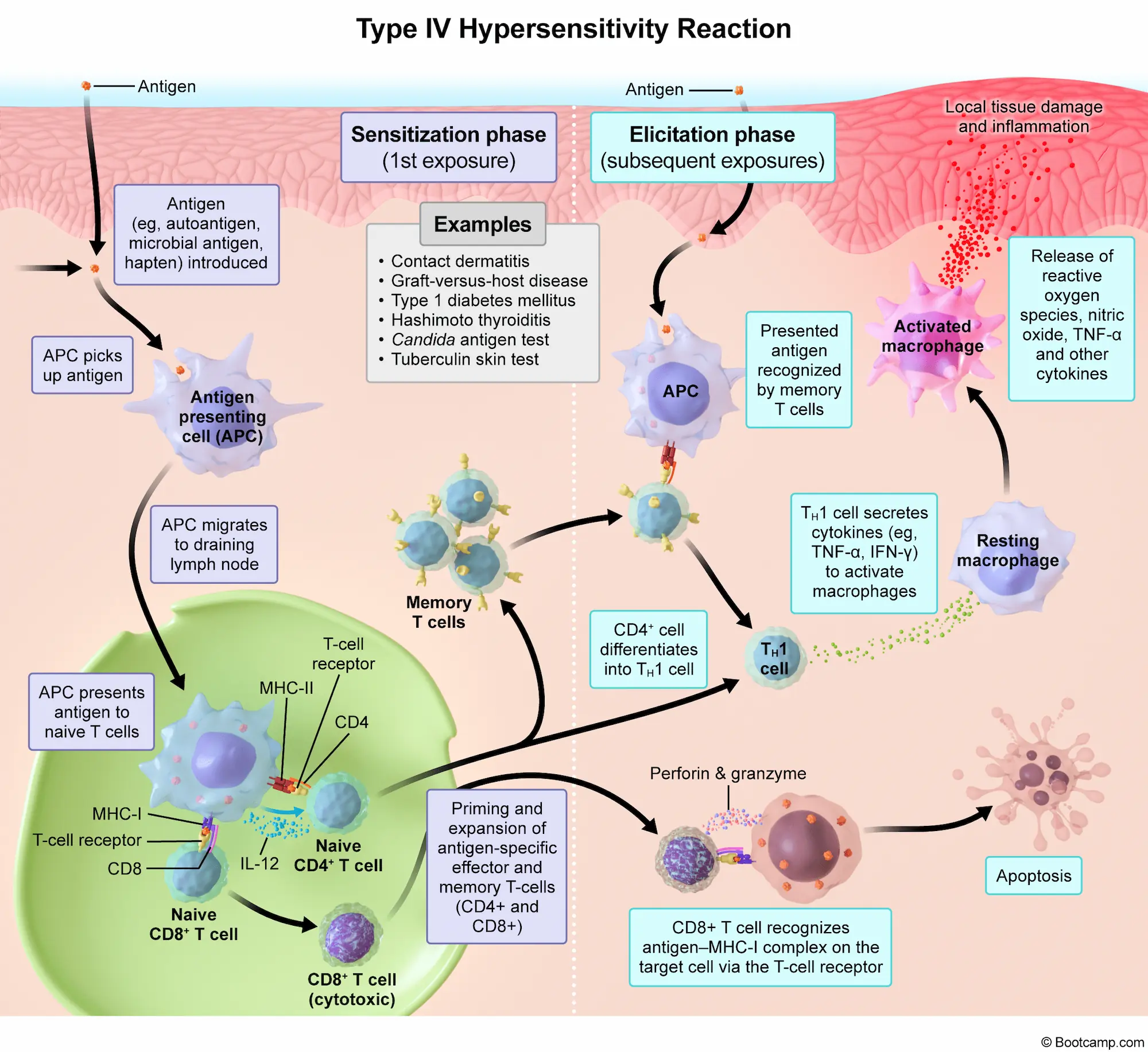 Type IV Hypersensitivity Reaction