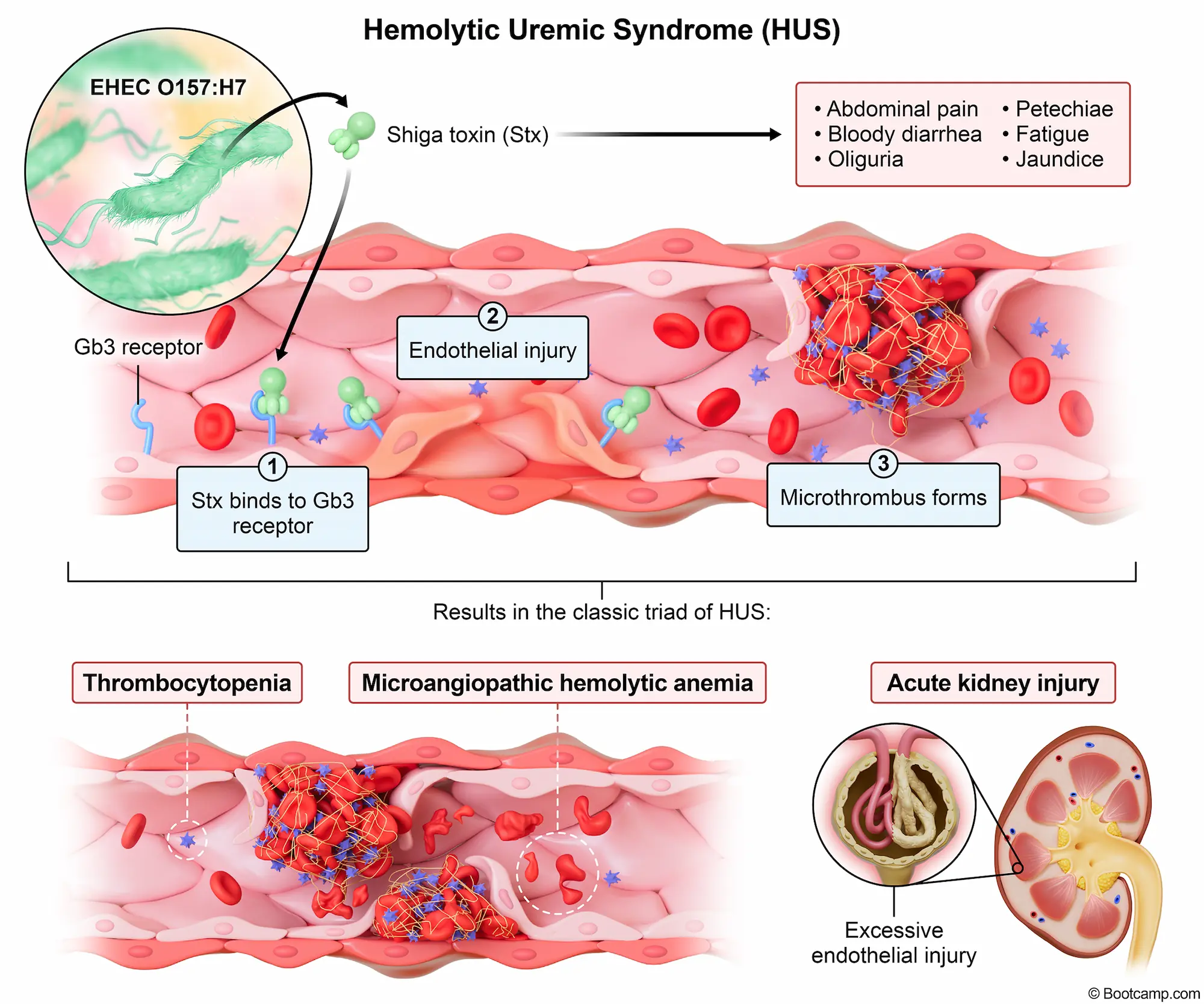 Hemolytic Uremic Syndrome (HUS)