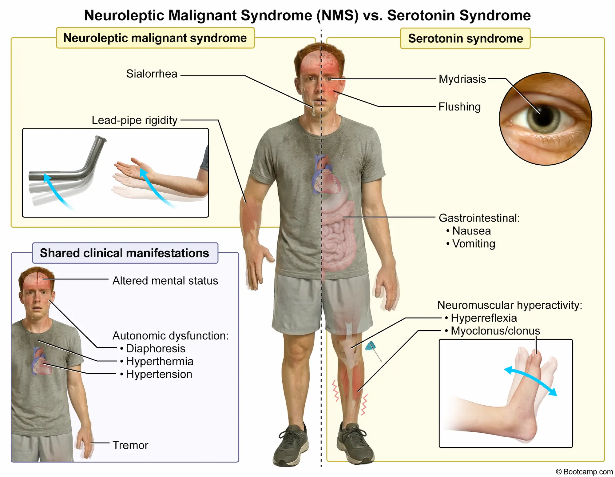 Neuroleptic Malignant Syndrome NMS vs. Serotonin Syndrome