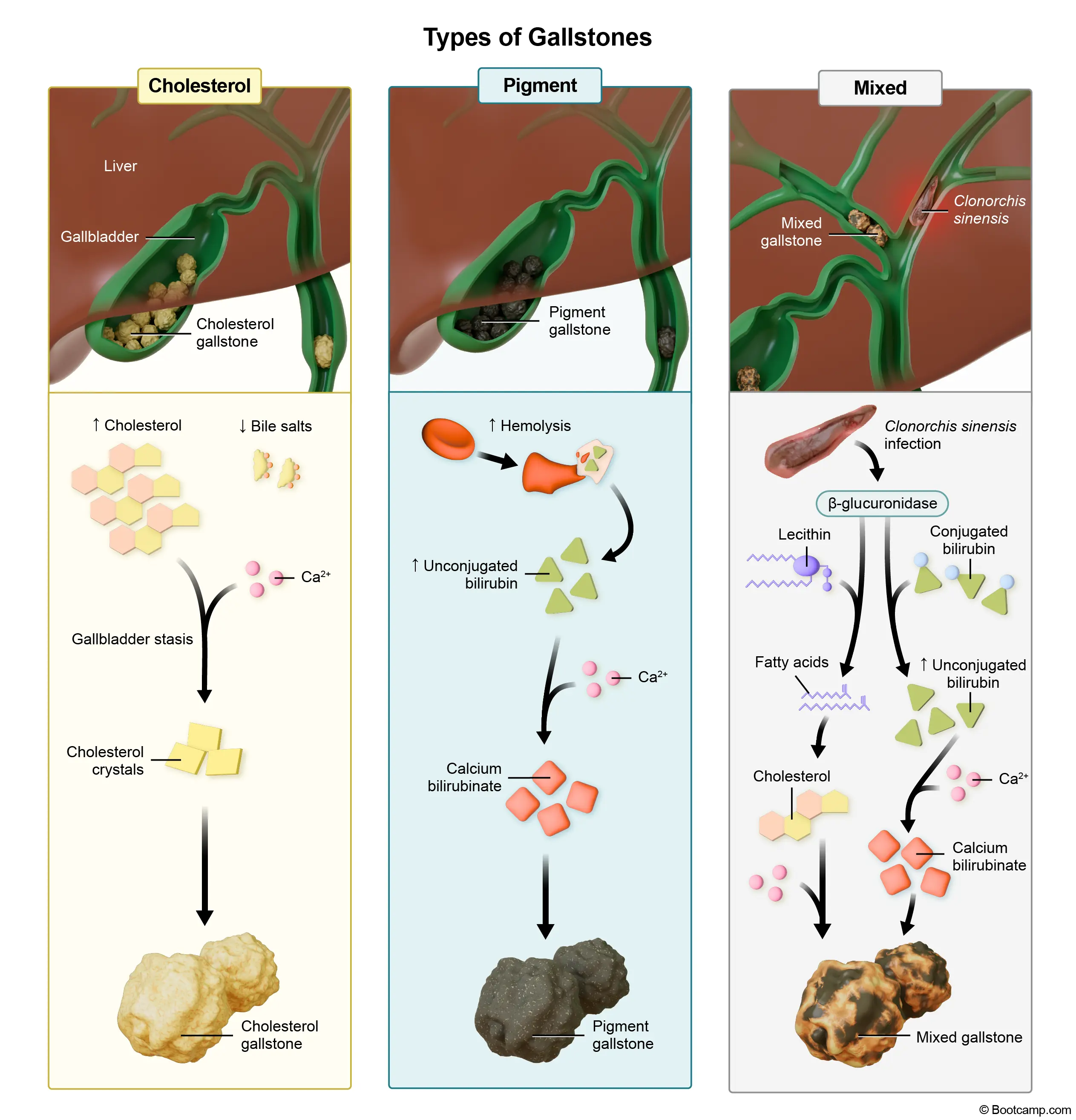 Types of Gallstones