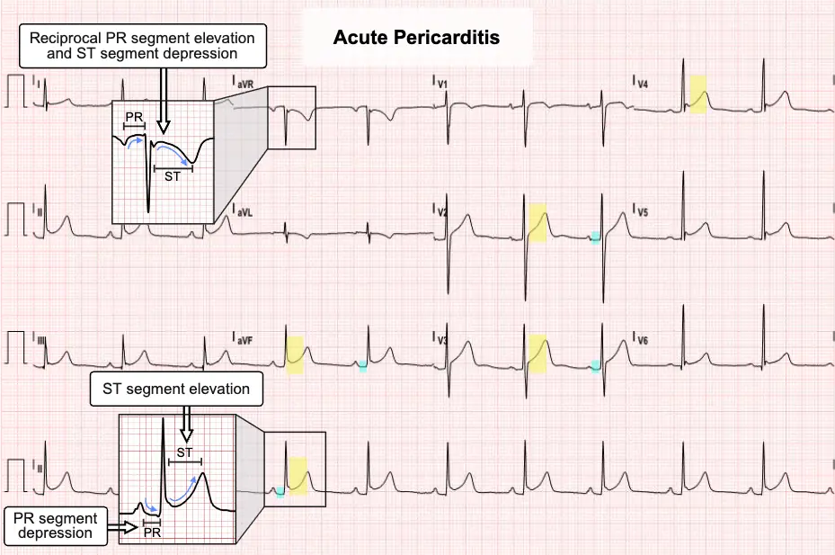 Acute Pericarditis