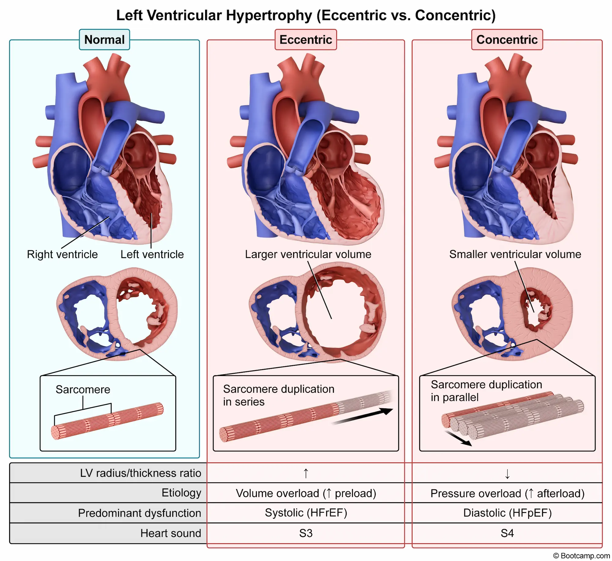 Left Ventricular Hypertrophy (Eccentric vs. Concentric)