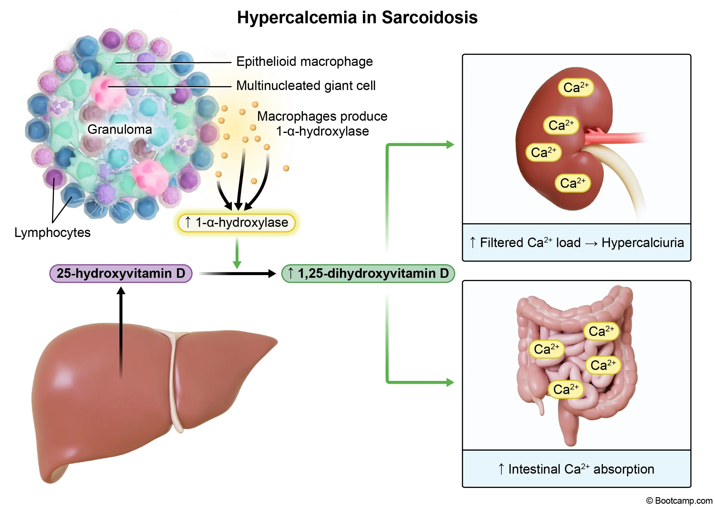 Hypercalcemia in Sarcoidosis