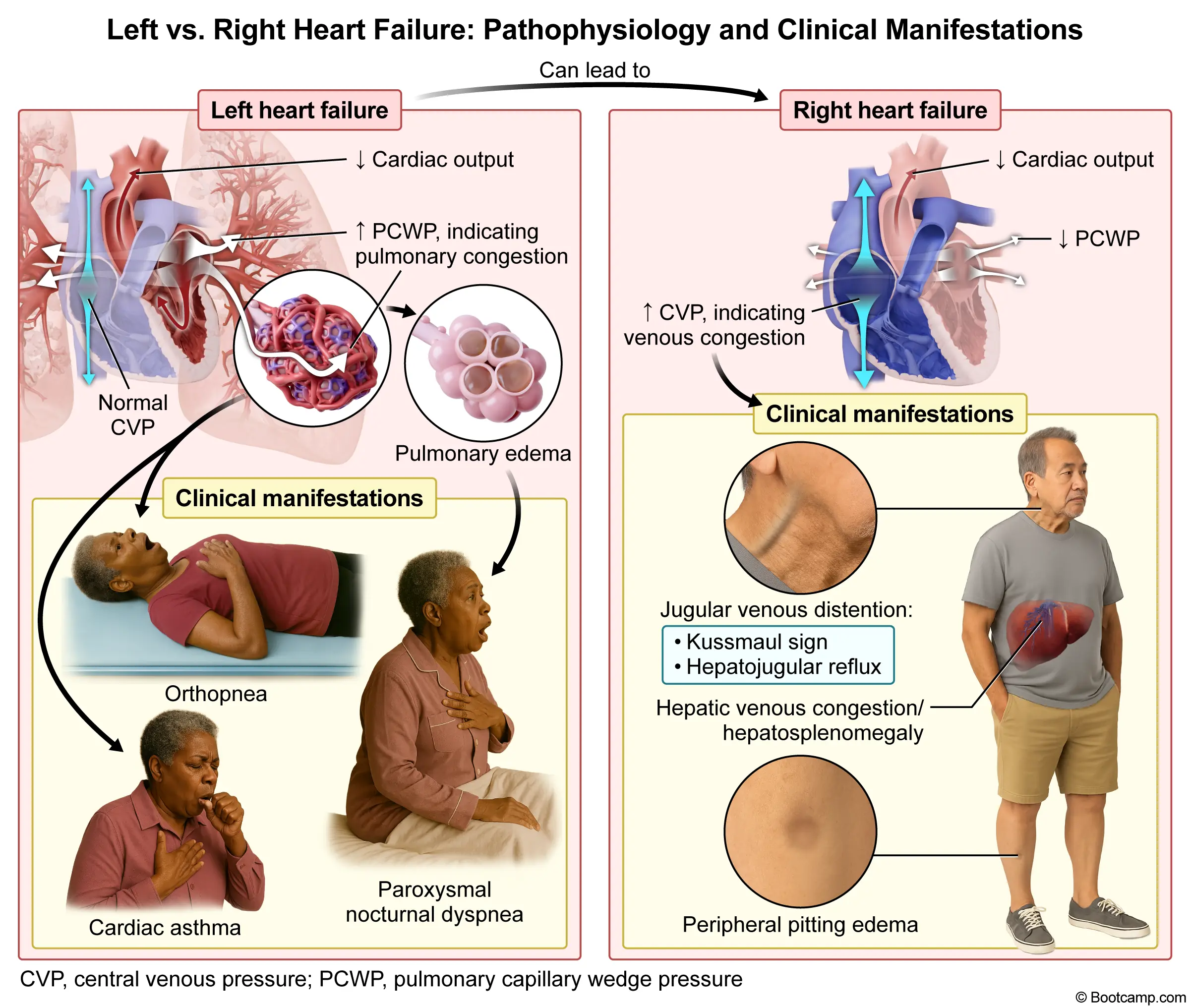 Left vs Right Heart Failure