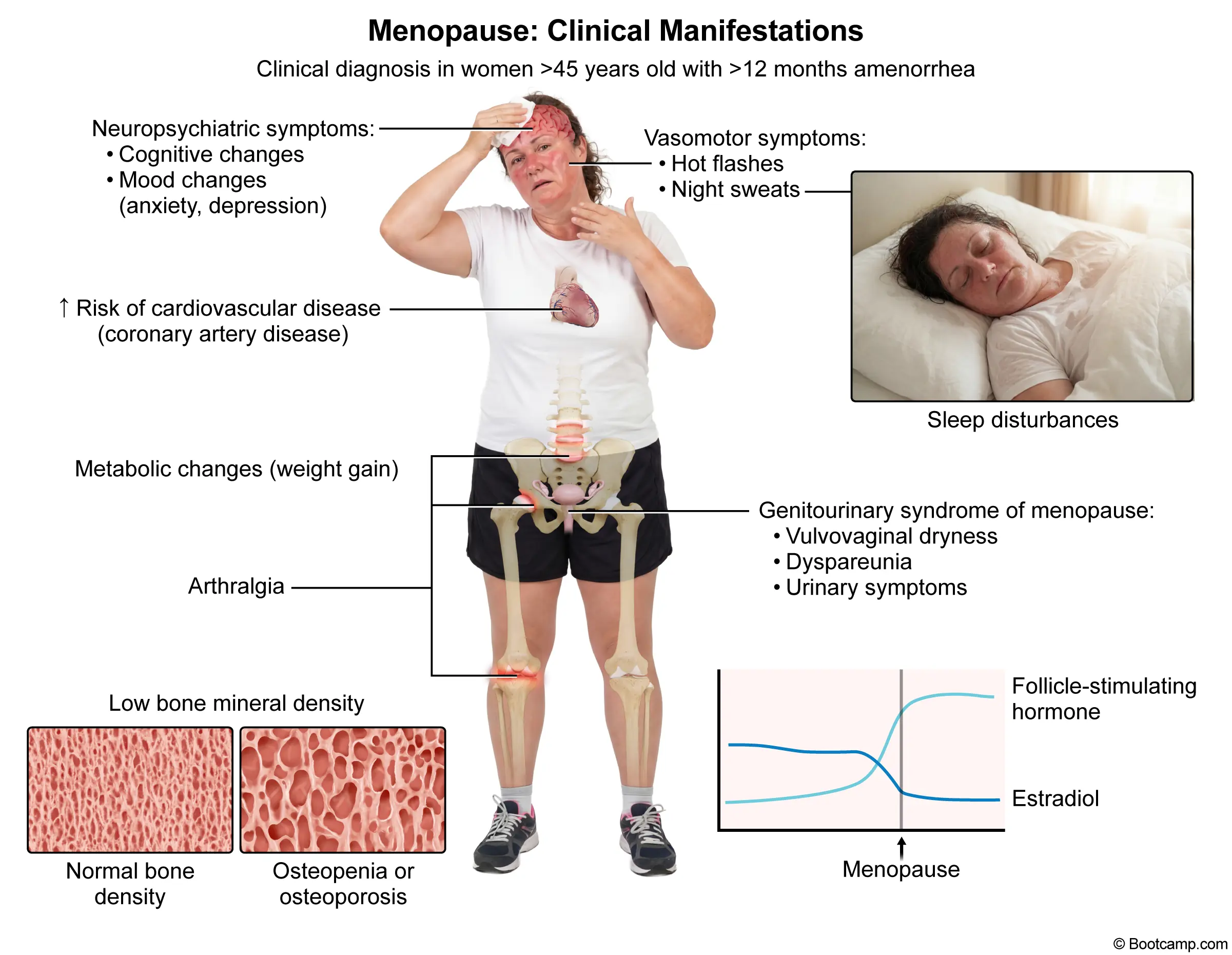 Menopause: Clinical Manifestations