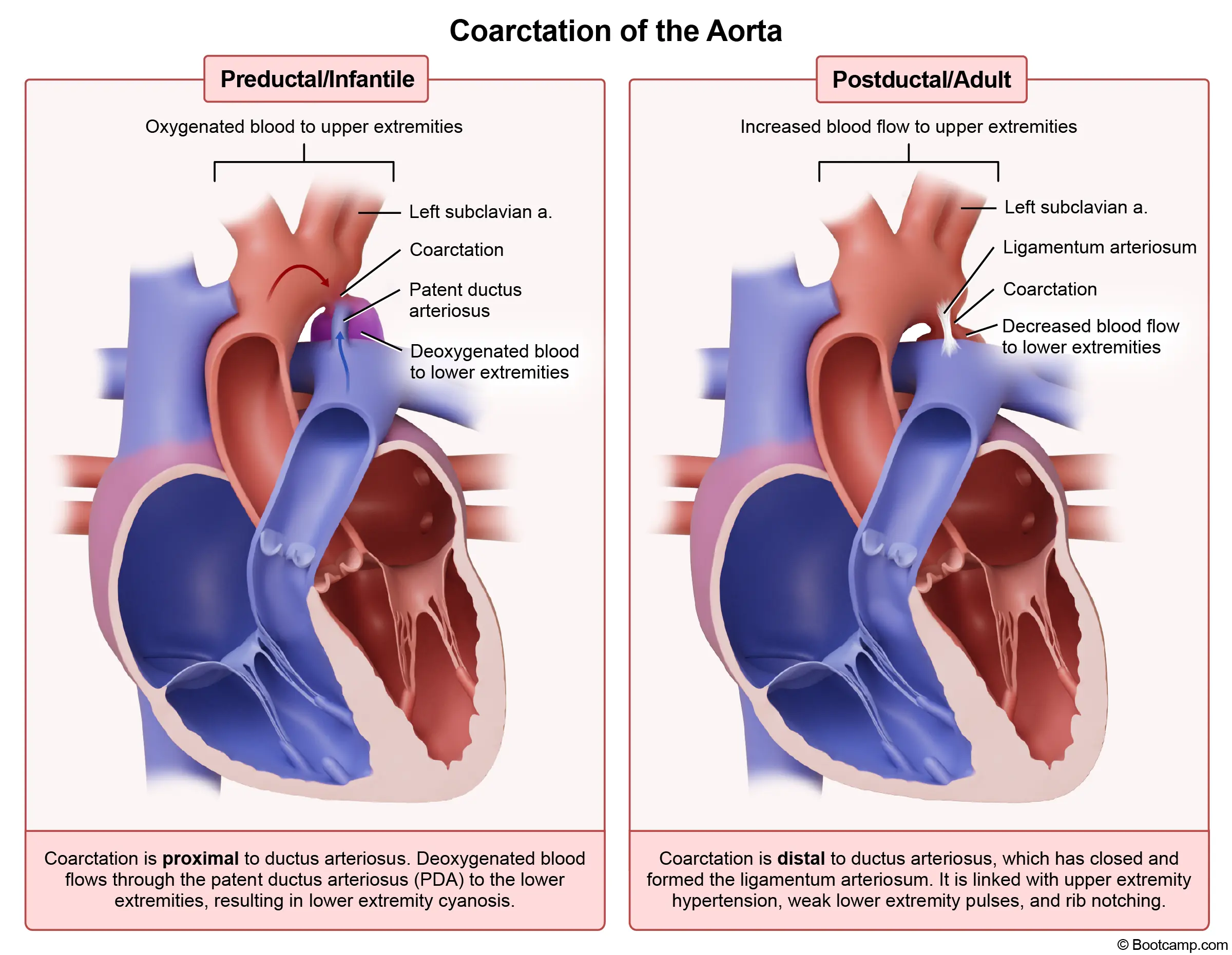 Coarctation of the Aorta