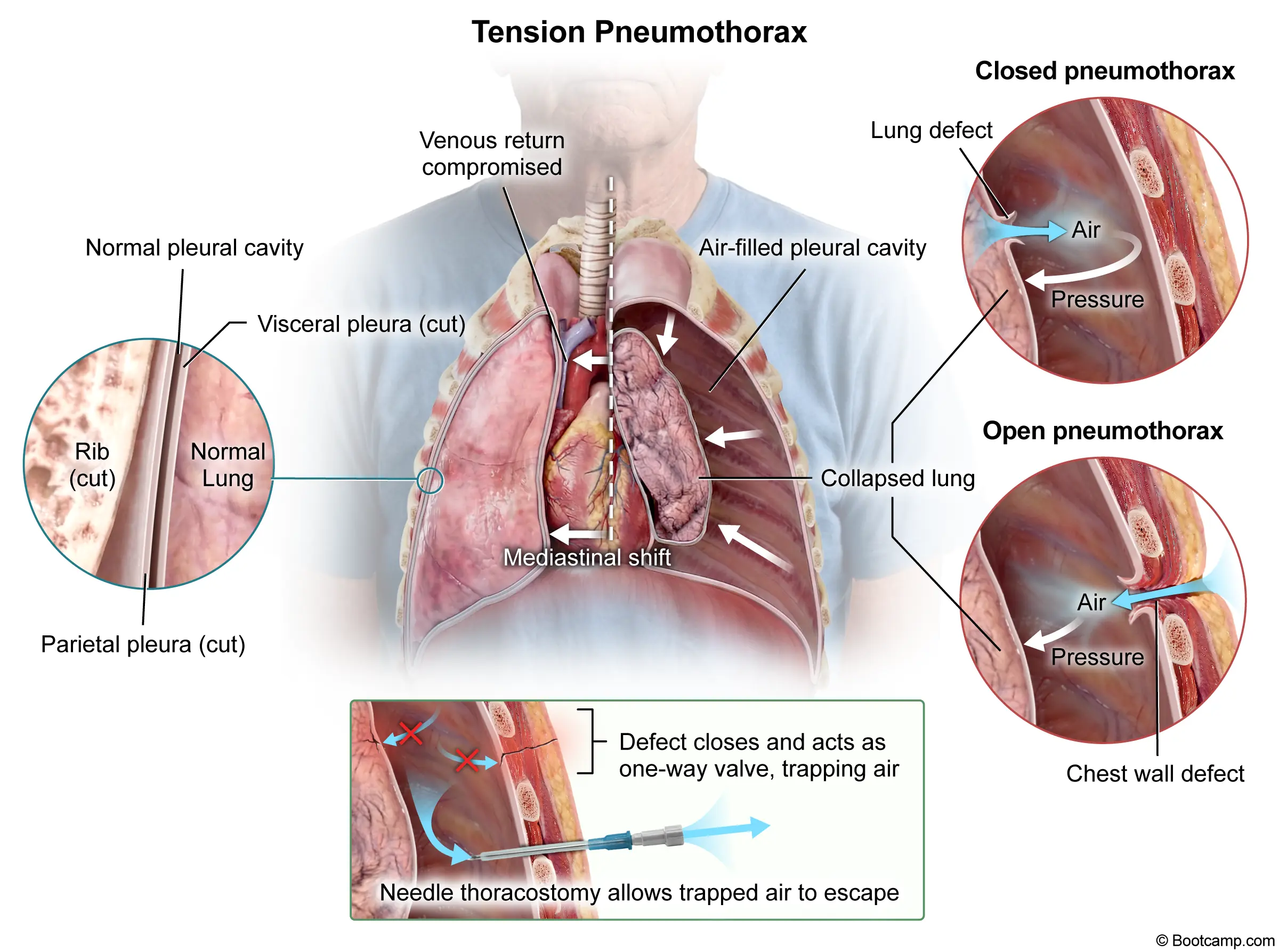 Tension Pneumothorax