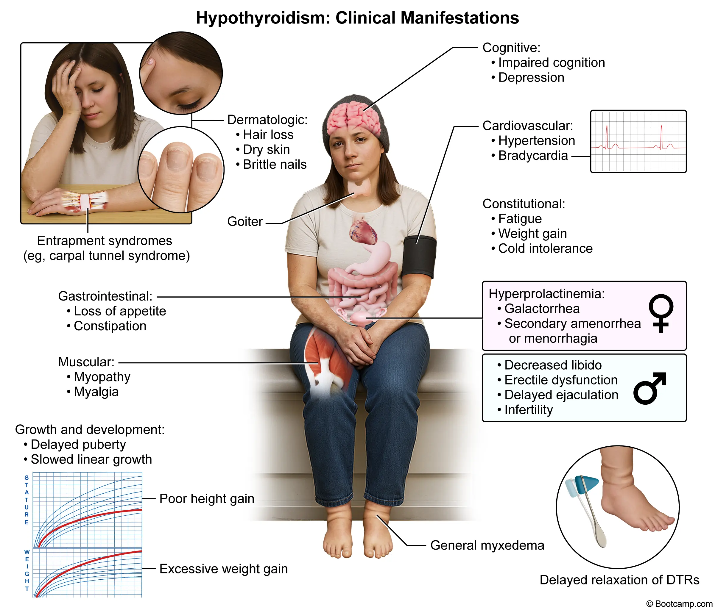 Hypothyroidism: Clinical Manifestations