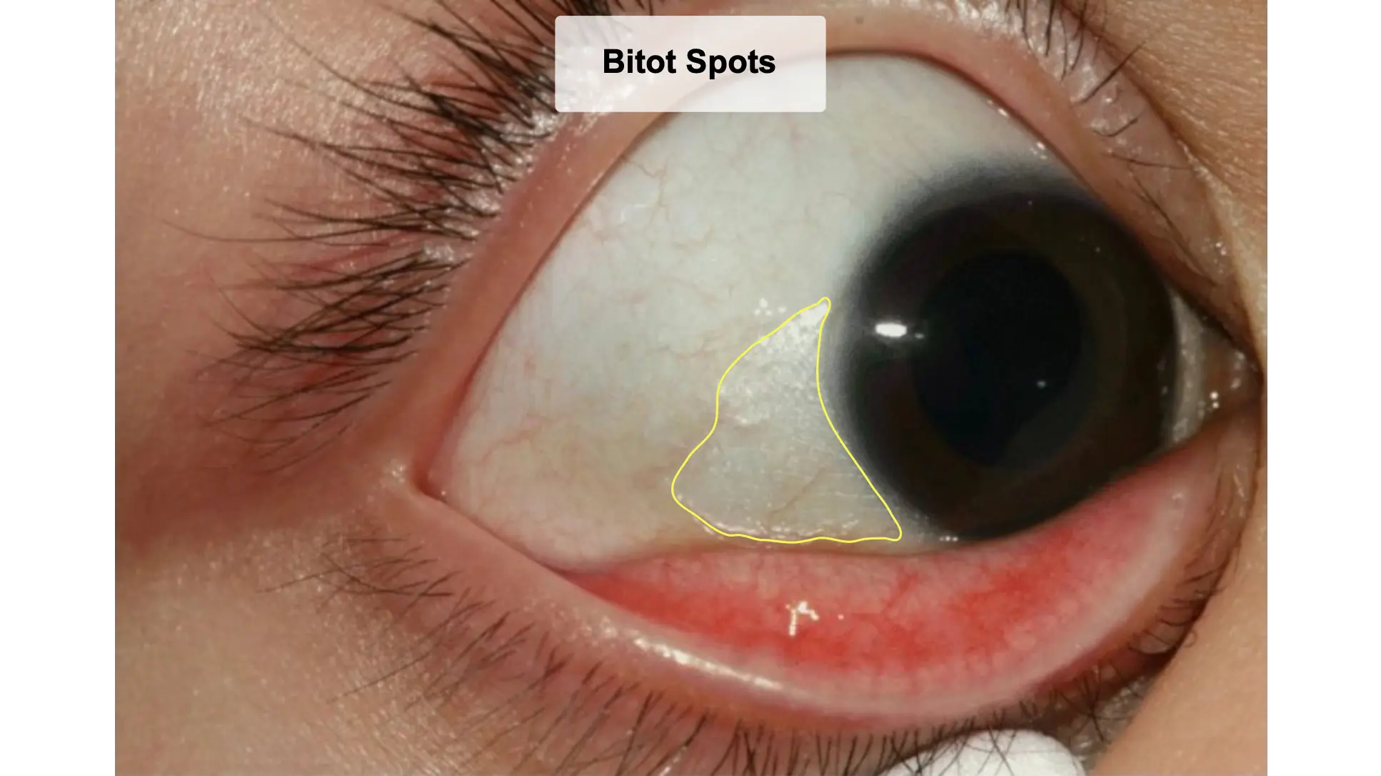 Bitot Spots