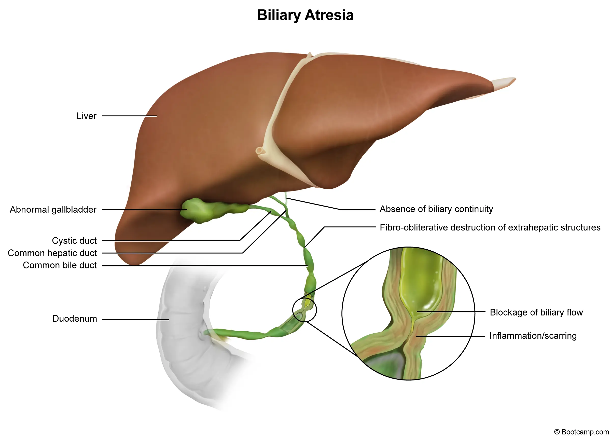 Biliary Atresia