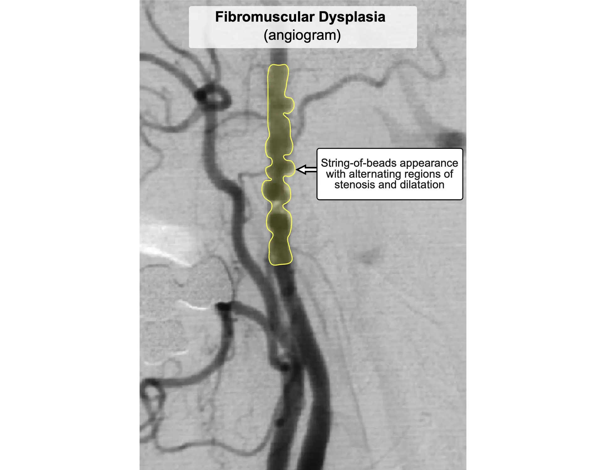 Fibromuscular Dysplasia Angiogram