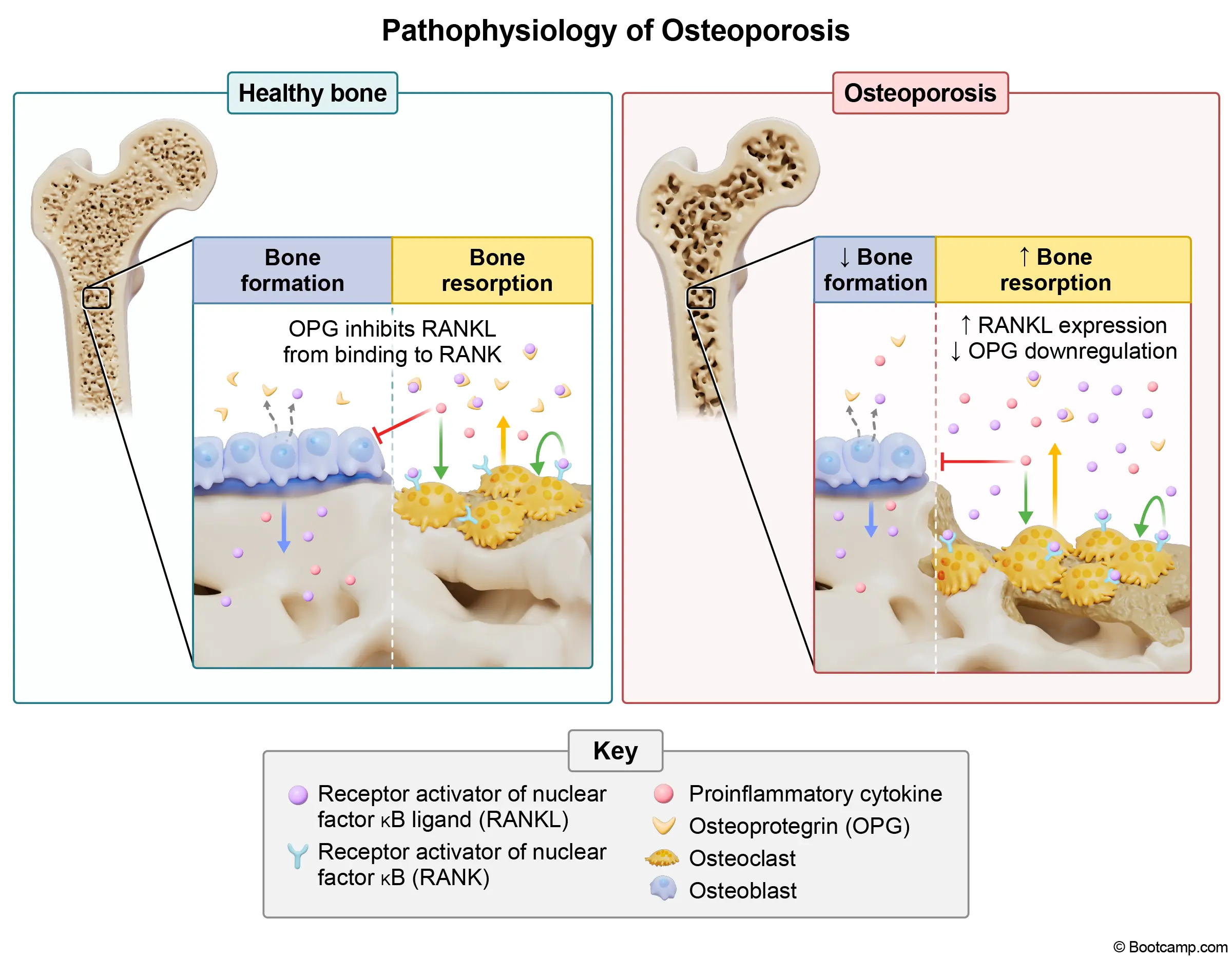 Pathophysiology of Osteoporosis