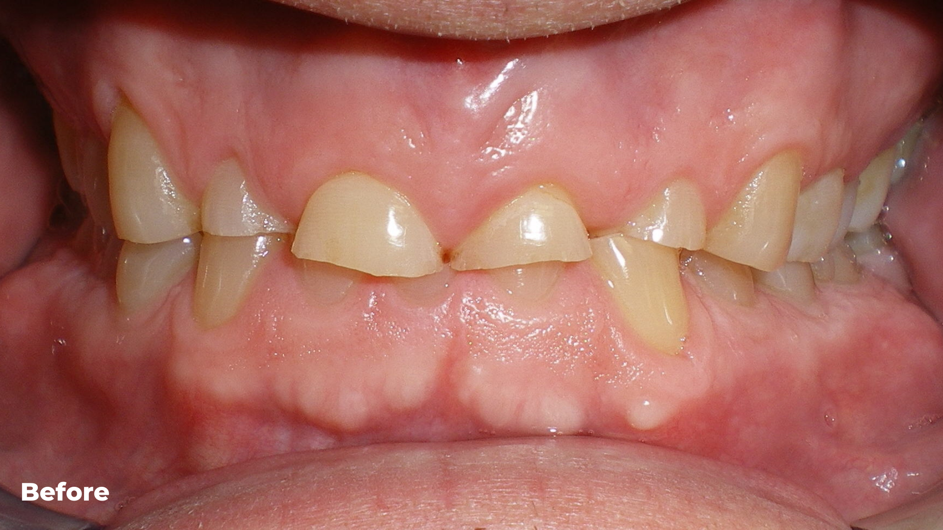 Orthodontic combined with Restorative Treatment