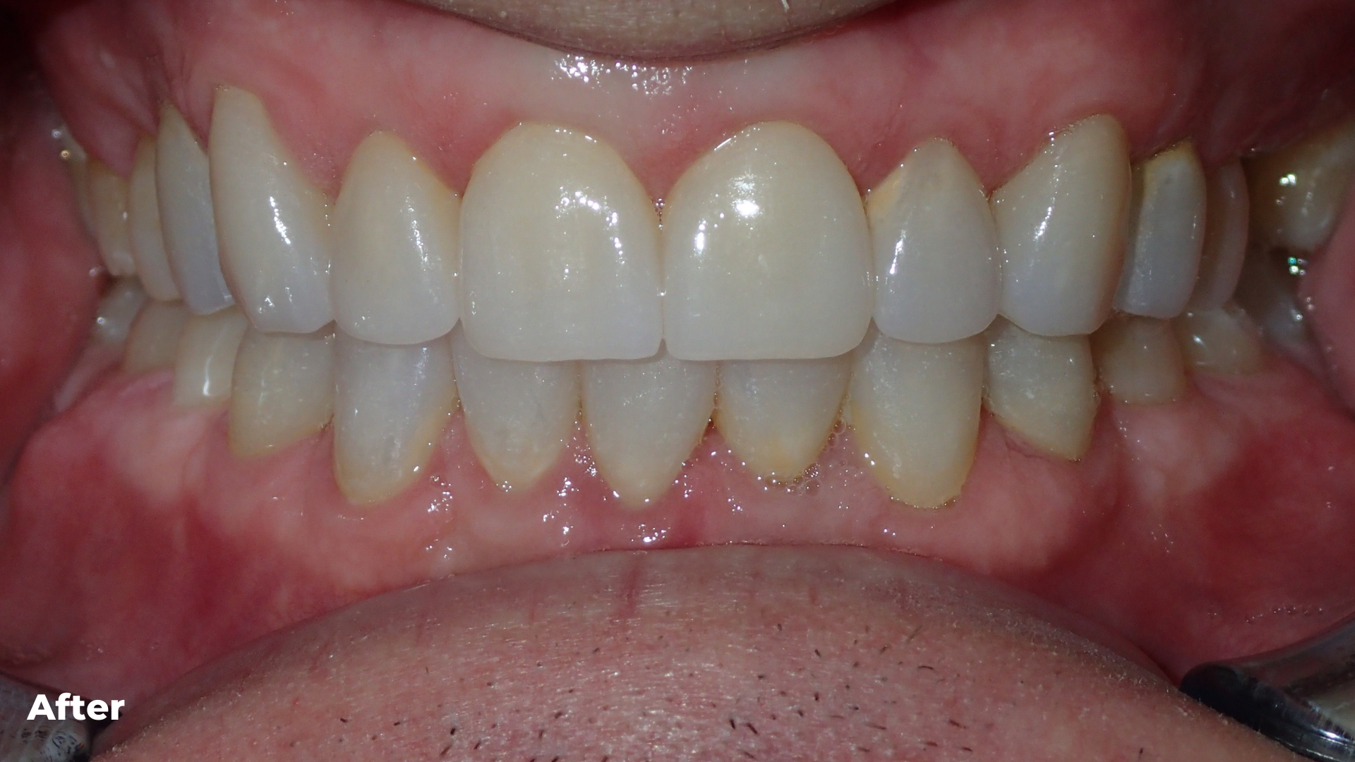 Orthodontic combined with Restorative Treatment