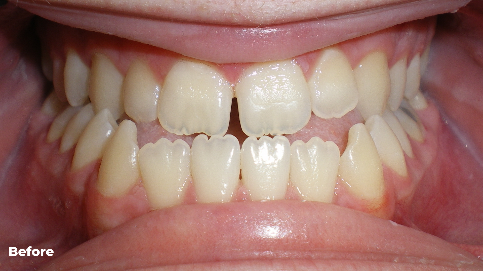 Underbite combined with Jaw Surgery Treatment