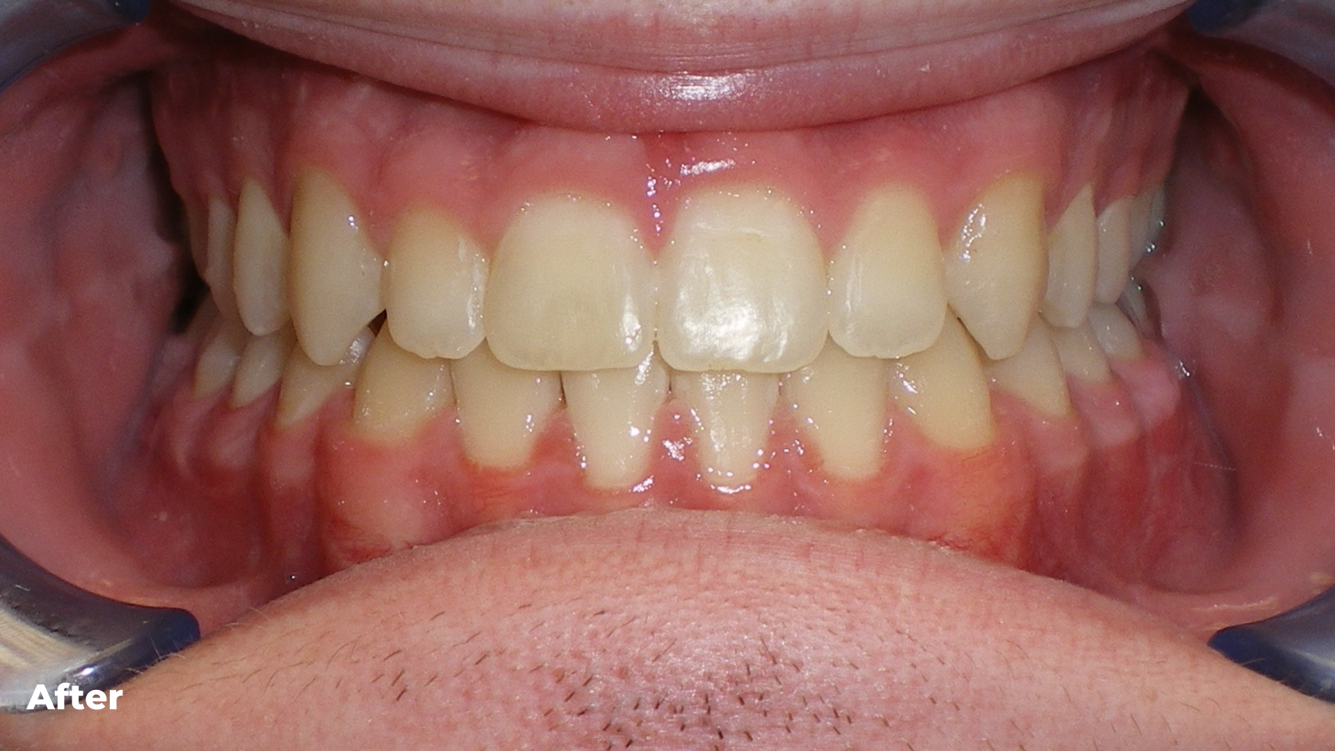 Underbite combined with Jaw Surgery Treatment