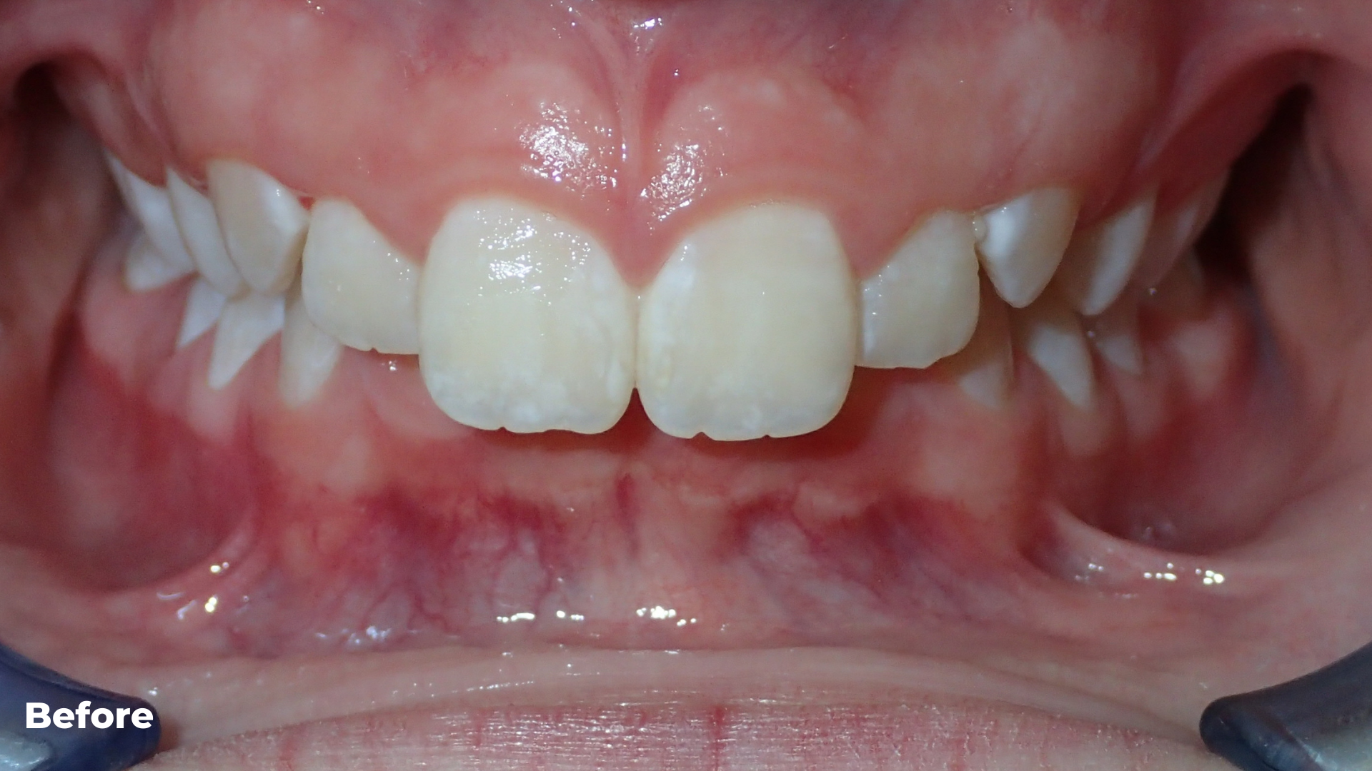 Deep Bite and Overbite Treatment