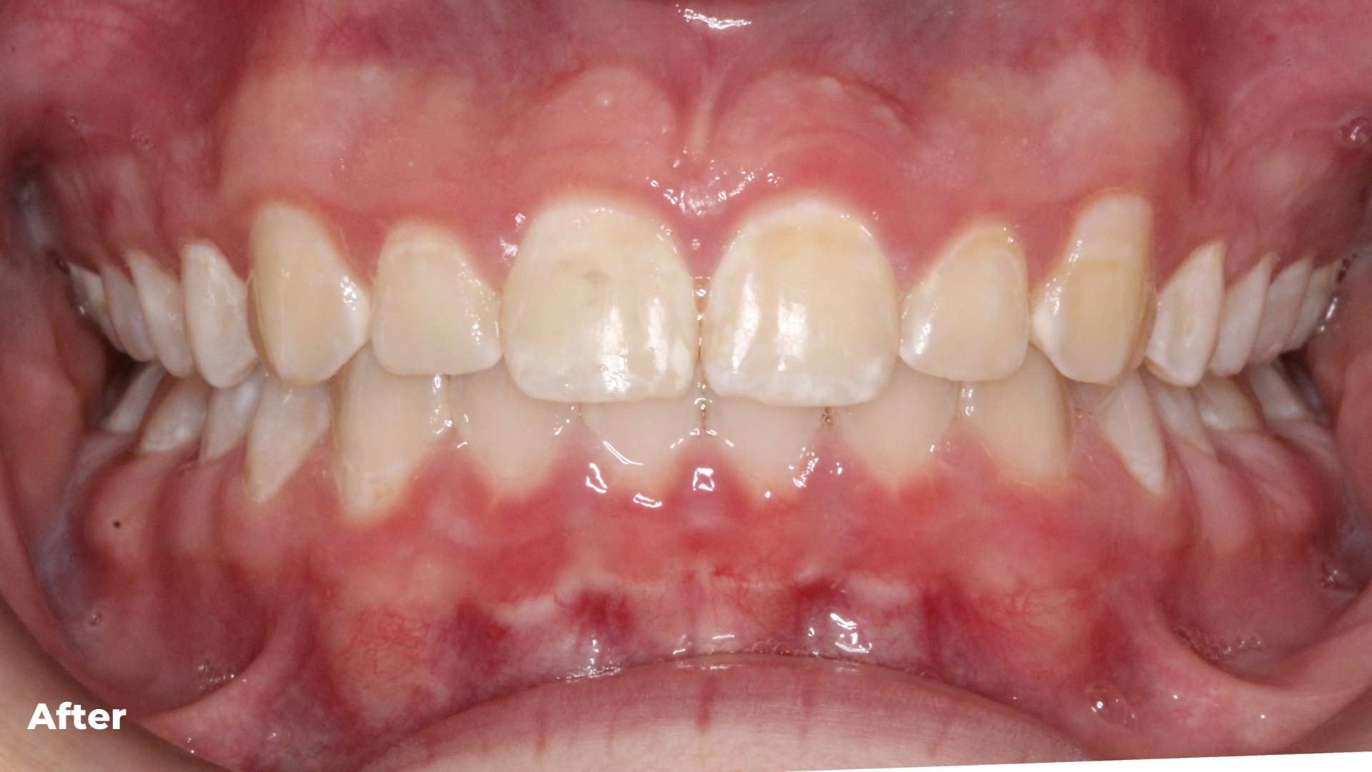 Deep Bite and Overbite Treatment