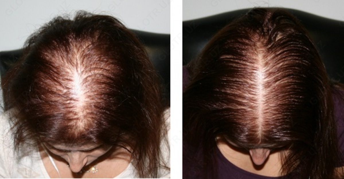 HairActiv 2
