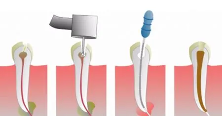 koreninsko zdravljenje zoba