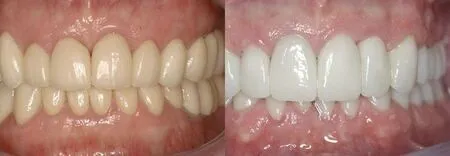 cirkonijeva prevleka