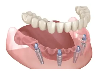 all on 4 fiksna proteza na implantatih