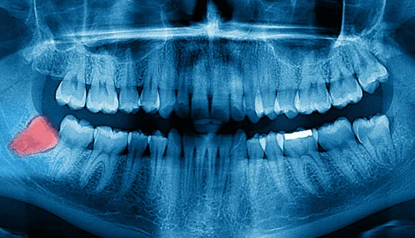 Estetsko zobozdravstvo – beljenje zob