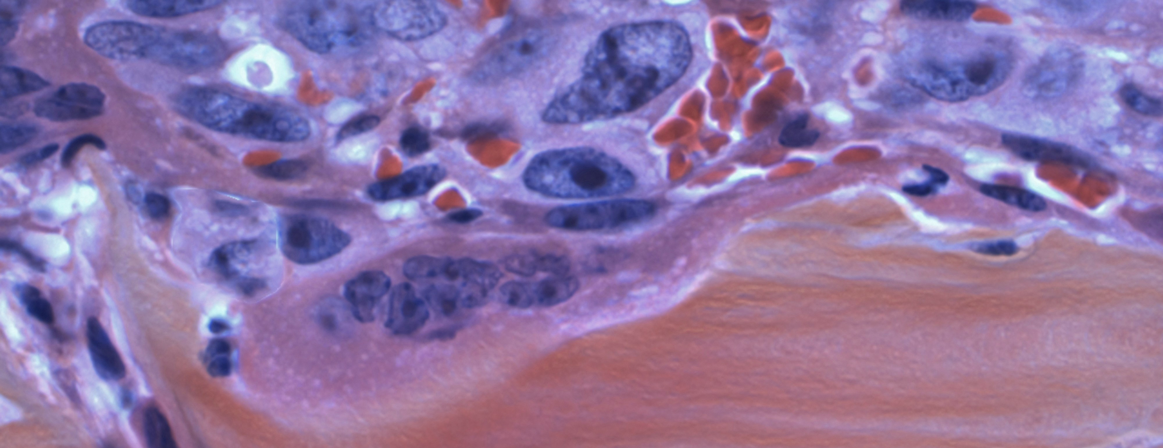 Mākslīgā intelekta vadīta nelabvēlīgu audzēju un metastāžu diagnostikas risinājuma izstrāde (OncoAIM)