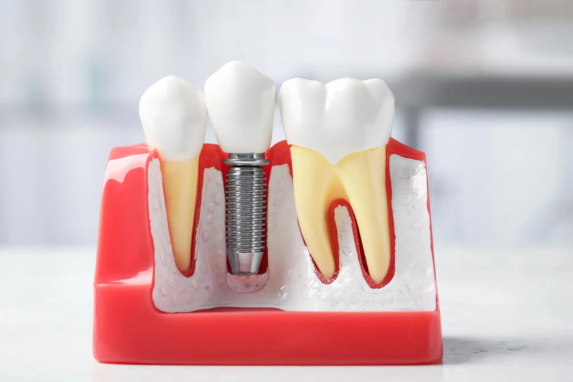 model of Dental Implants Candler