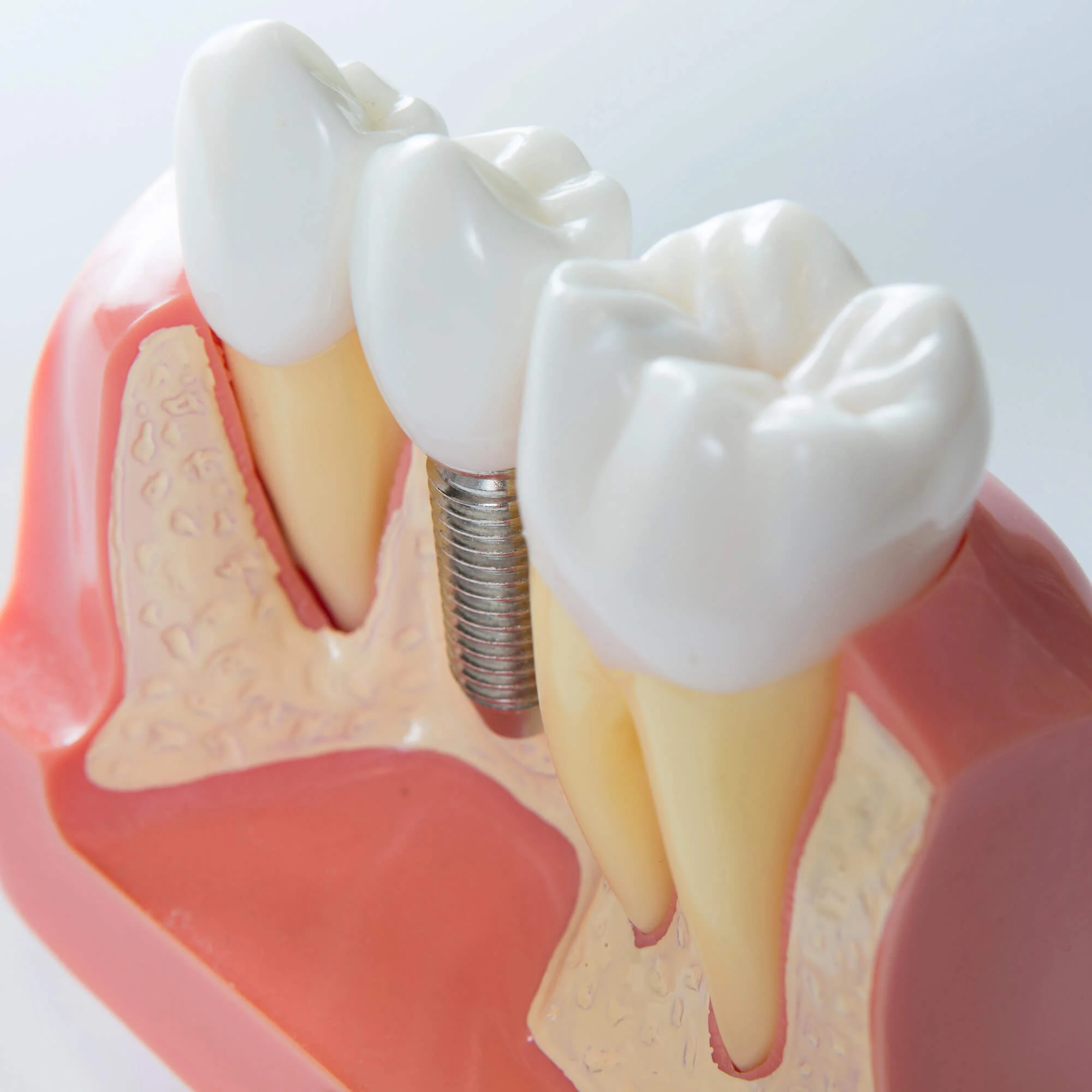 Tooth implant model showing structure, dental implants in Candler