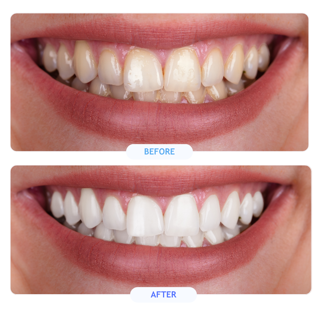 invisalign frequently asked questions