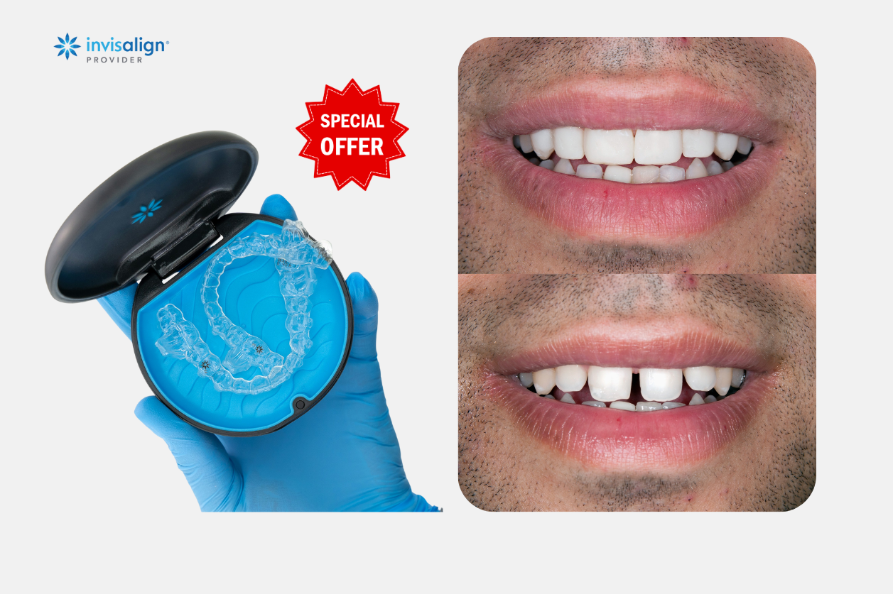 invisalign frequently asked questions