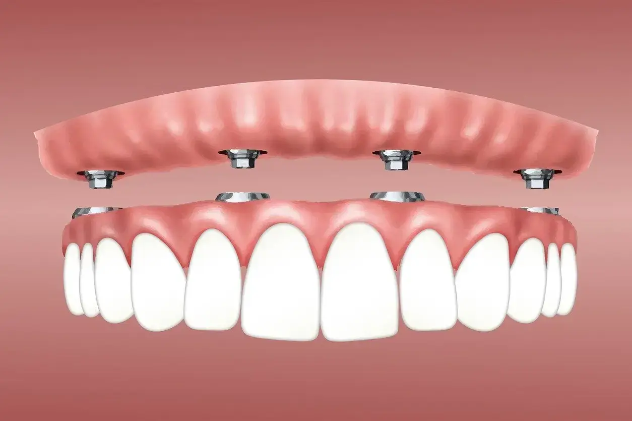 Step by step dental implant procedure illustration with titanium post and crown